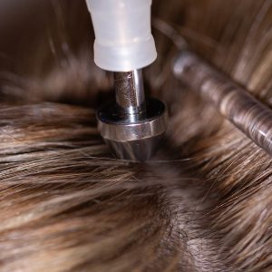 Tratamiento capilar virtual con exosomas. Clínica estética Barcelona